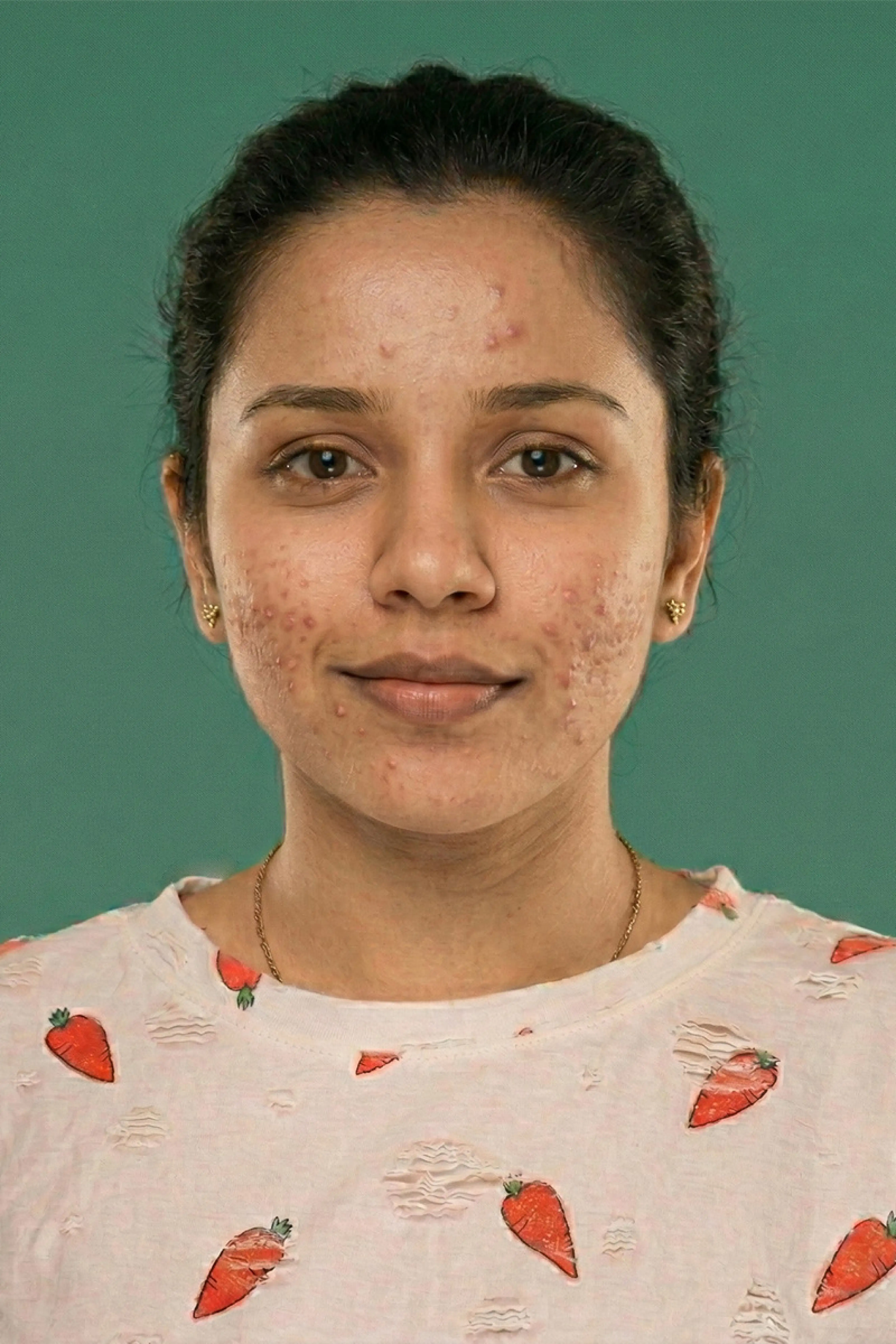Online acne consultation with dermatologist